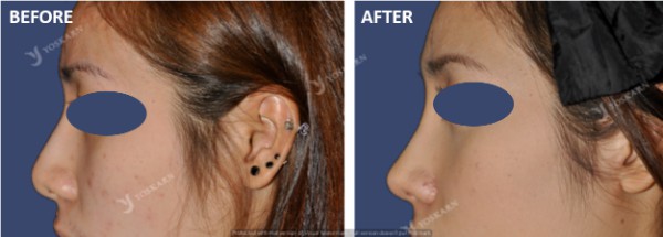 Rhinoplasty Clinic Thailand  and dermatology center