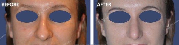 Rhinoplasty Clinic Thailand  and dermatology center