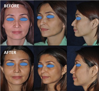 Rhinoplasty Thailand and dermatology center