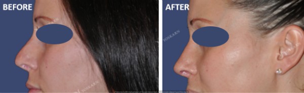 Rhinoplasty Clinic Thailand  and dermatology center