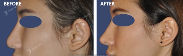 Rhinoplasty Clinic Thailand  and dermatology center