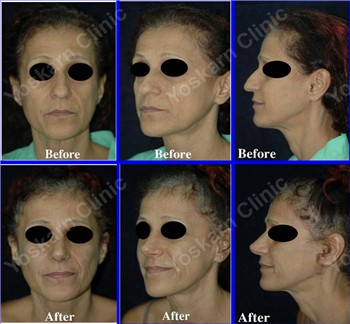 Rhinoplasty Clinic Thailand  and dermatology center