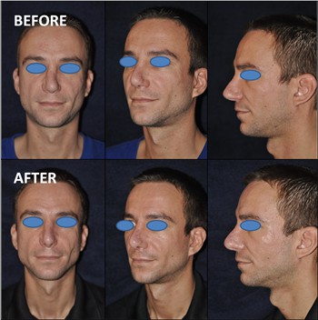 Rhinoplasty Clinic Thailand  and dermatology center