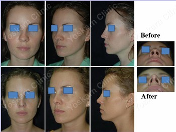 Rhinoplasty Clinic Thailand  and dermatology center