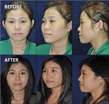 Rhinoplasty Clinic Thailand  and dermatology center