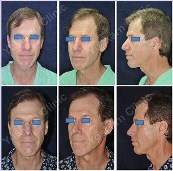 Rhinoplasty Clinic Thailand  and dermatology center