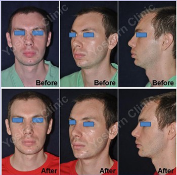 Rhinoplasty Clinic Thailand  and dermatology center