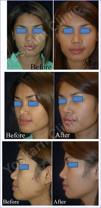 Rhinoplasty Clinic Thailand  and dermatology center