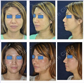 Rhinoplasty Clinic Thailand  and dermatology center