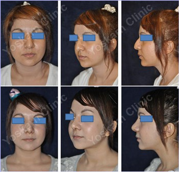 Rhinoplasty Clinic Thailand  and dermatology center