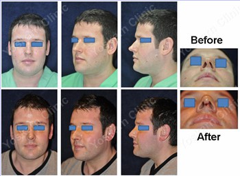 Rhinoplasty Clinic Thailand  and dermatology center