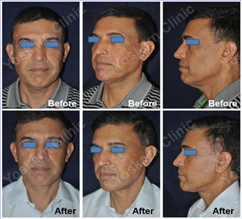 Rhinoplasty Clinic Thailand  and dermatology center