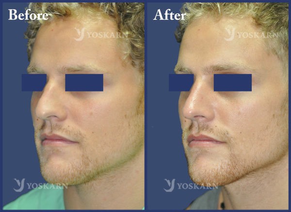 Rhinoplasty Clinic Thailand  and dermatology center