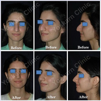 Rhinoplasty Clinic Thailand  and dermatology center