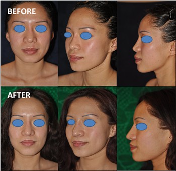 Rhinoplasty Clinic Thailand  and dermatology center