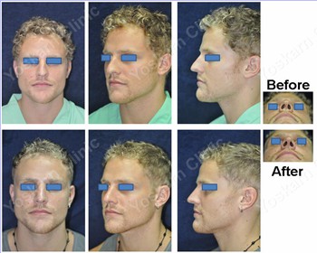 Rhinoplasty Clinic Thailand  and dermatology center