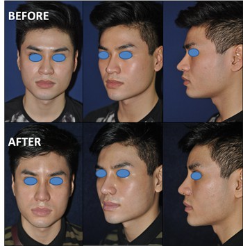 Rhinoplasty Clinic Thailand  and dermatology center
