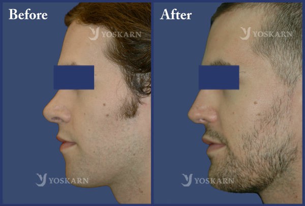 Rhinoplasty Clinic Thailand  and dermatology center