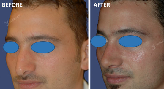 Bridge Augmentation/Reduction