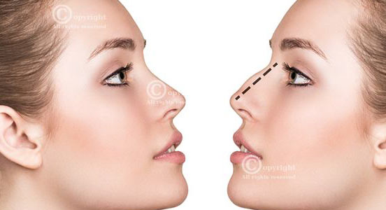 Deviated Septum Correction