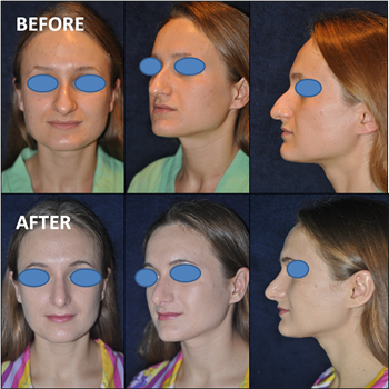 sian Rhinoplasty Thailand
