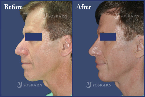 Botox Nose Shaping Thailand