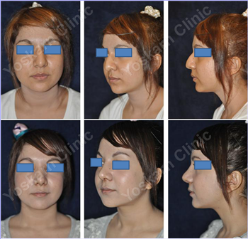 Functional Rhinoplasty Thailand