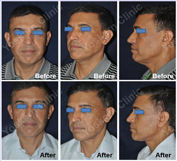 Liquid Rhinoplasty Thailand