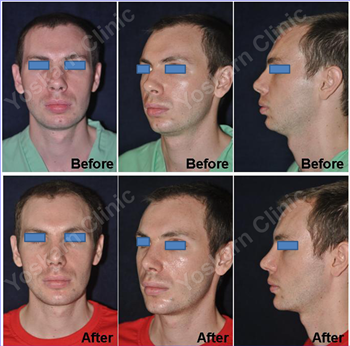 Long-term Rhinoplasty Follow-up