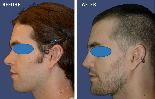 Open Rhinoplasty Thailand