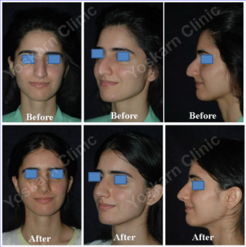 Primary Rhinoplasty Thailand