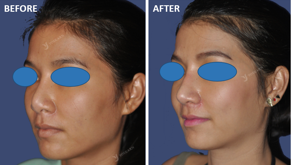 Revision Rhinoplasty Thailand