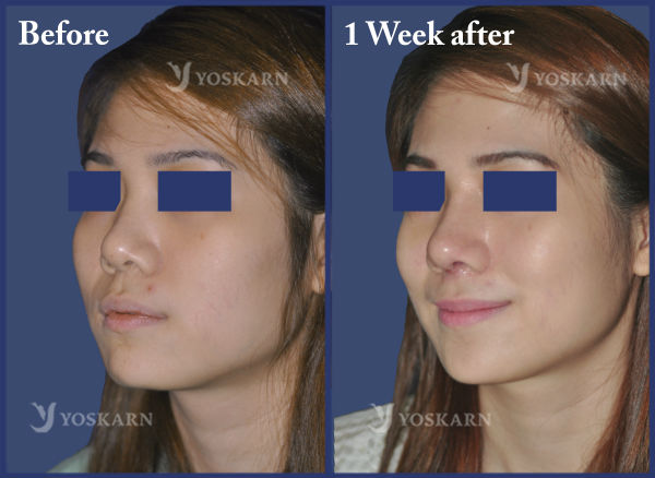 Rhinoplasty with Cheek Augmentation Thailand