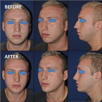 Functional Rhinoplasty Thailand