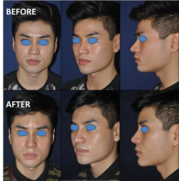 Rhinoplasty Types, Nose Surgery Thailand