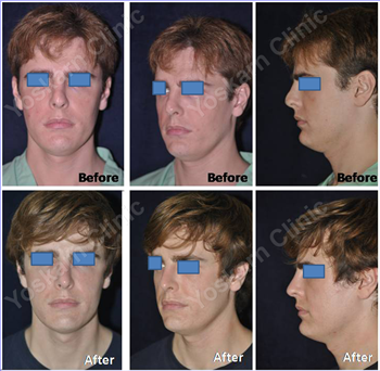 Nasal Splint Application