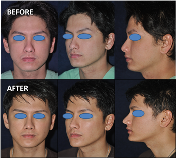  Facial Balance Surgery Thailand