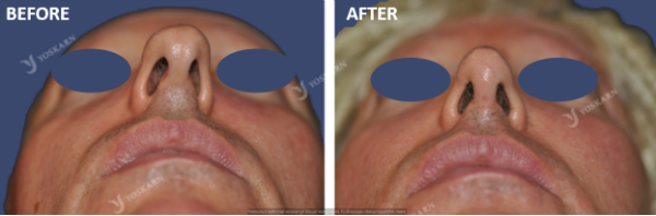 Nasal Tip Surgery Bangkok